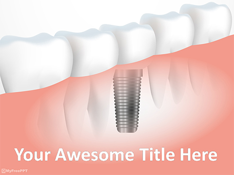 Tooth Implant PowerPoint Template